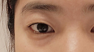 배원장님께 수술 받았어요 ! 눈밑지방재배치+필러