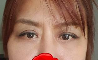 쌍수재수술