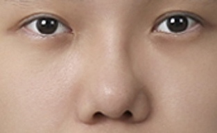 눈, 코 수술 후기